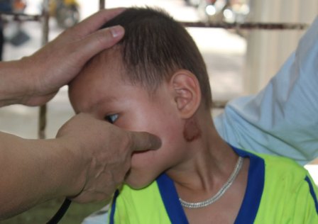 TP.Hồ Chí Minh: Xuất hiện chùm ca bệnh quai bị trong trường học