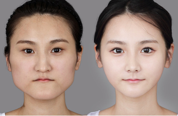 Phẫu thuật thẩm mỹ cùng những hệ lụy